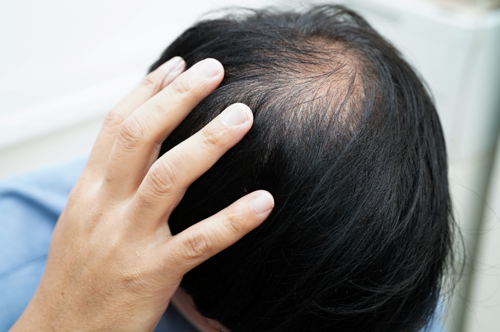 man examining hair balding concerns at home